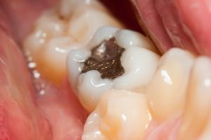 restauração no dente