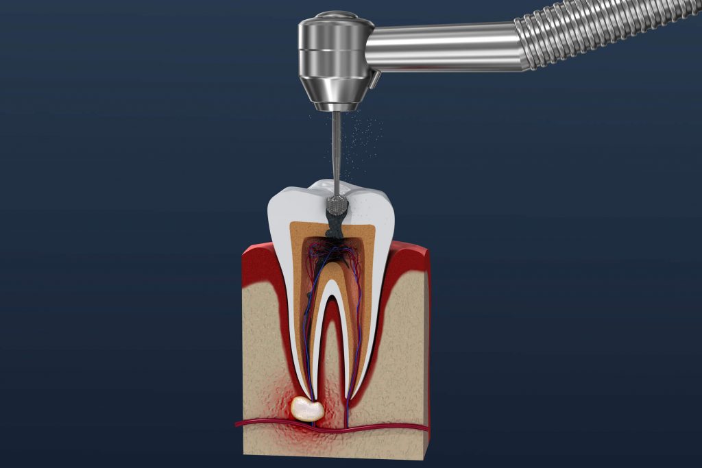 Tratamento De Canal Escurece O Dente Descubra Aqui OdontoCompany Sorria Que Da