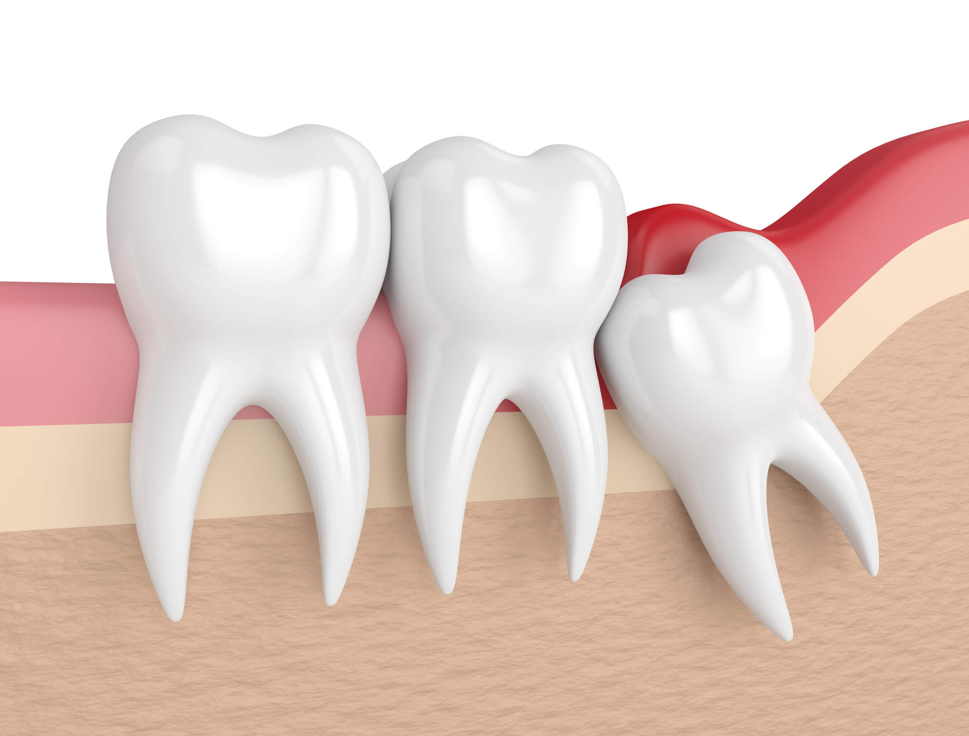 Featured image of post Imagens De Dente Siso : Basta passar um pouco de óleo de cravo em uma bola de algodão e isso pressione suavemente sobre o dente do siso doloroso e as gengivas circundantes.