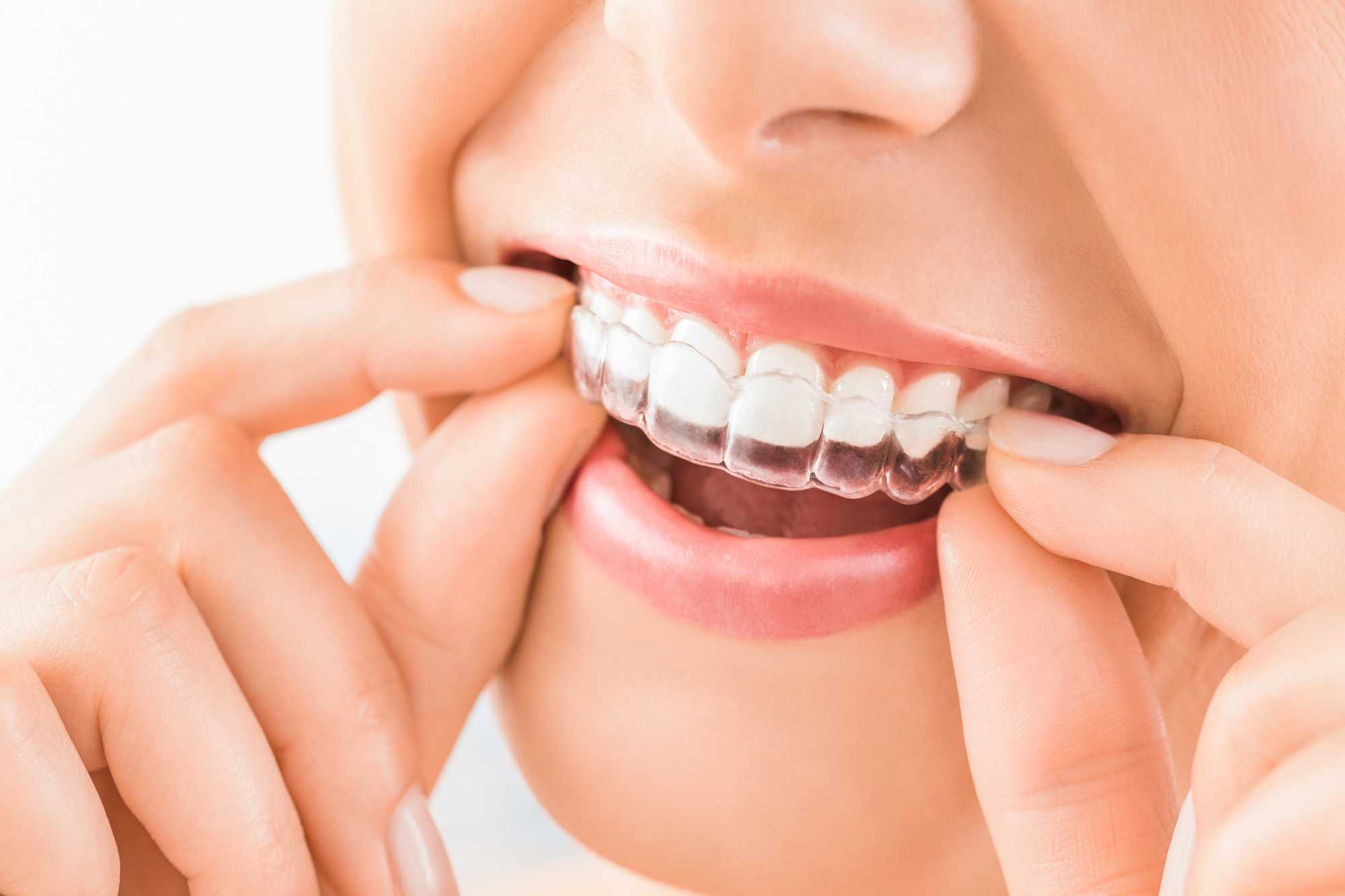 captar clientes para ortodontia