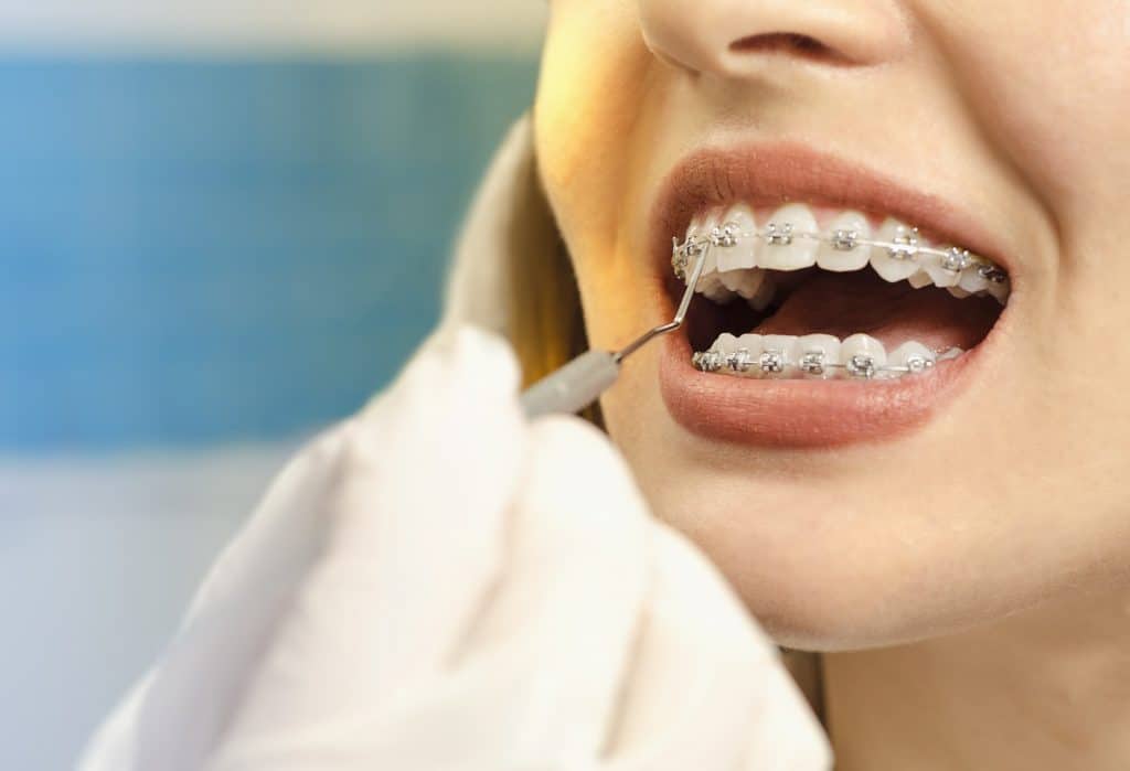 Os dentes podem entortar depois de usar aparelho? Confira aqui! Sorria que Da! Os dentes podem entortar depois de usar aparelho? Confira aqui! Sorria que Da!