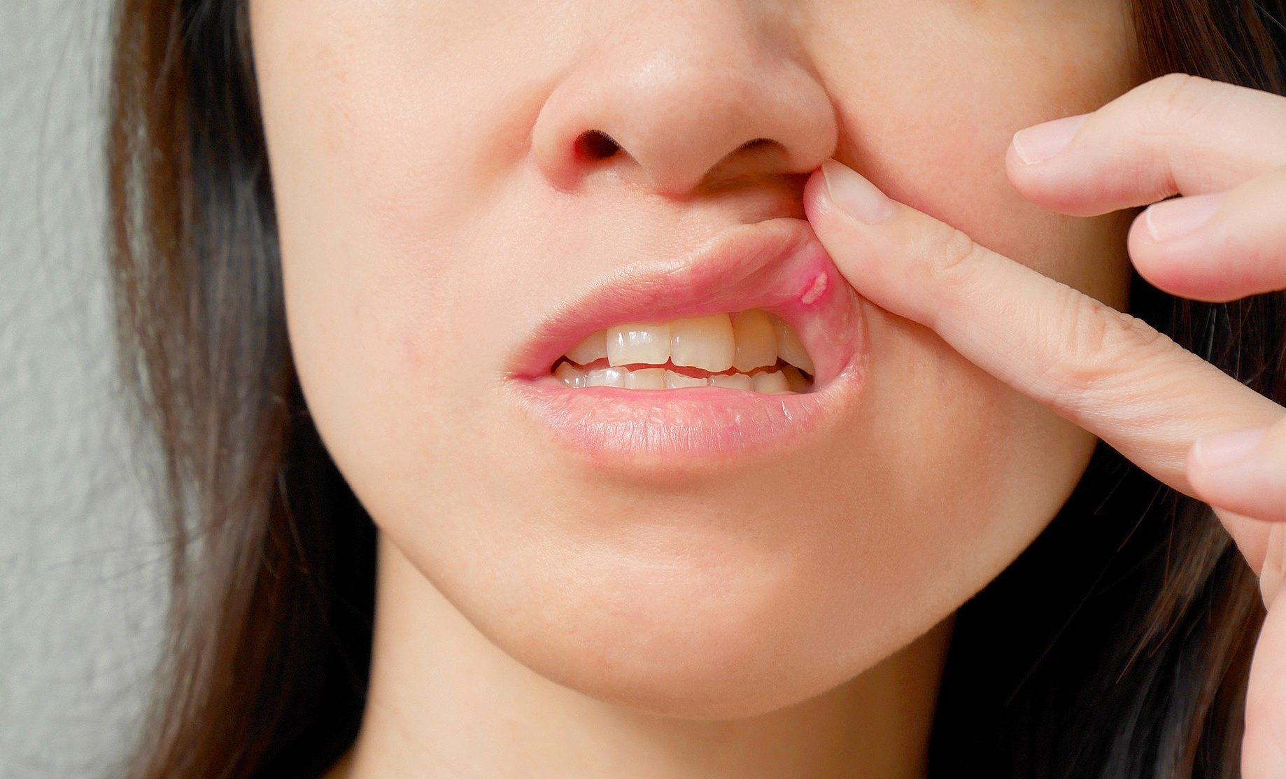 Afta na garganta: 7 principais causas (e o que fazer) - Tua Saúde