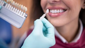 Quem tem lentes de contatos dentais pode usar Invisalign? – Dra. Marilia  Basso Affonso